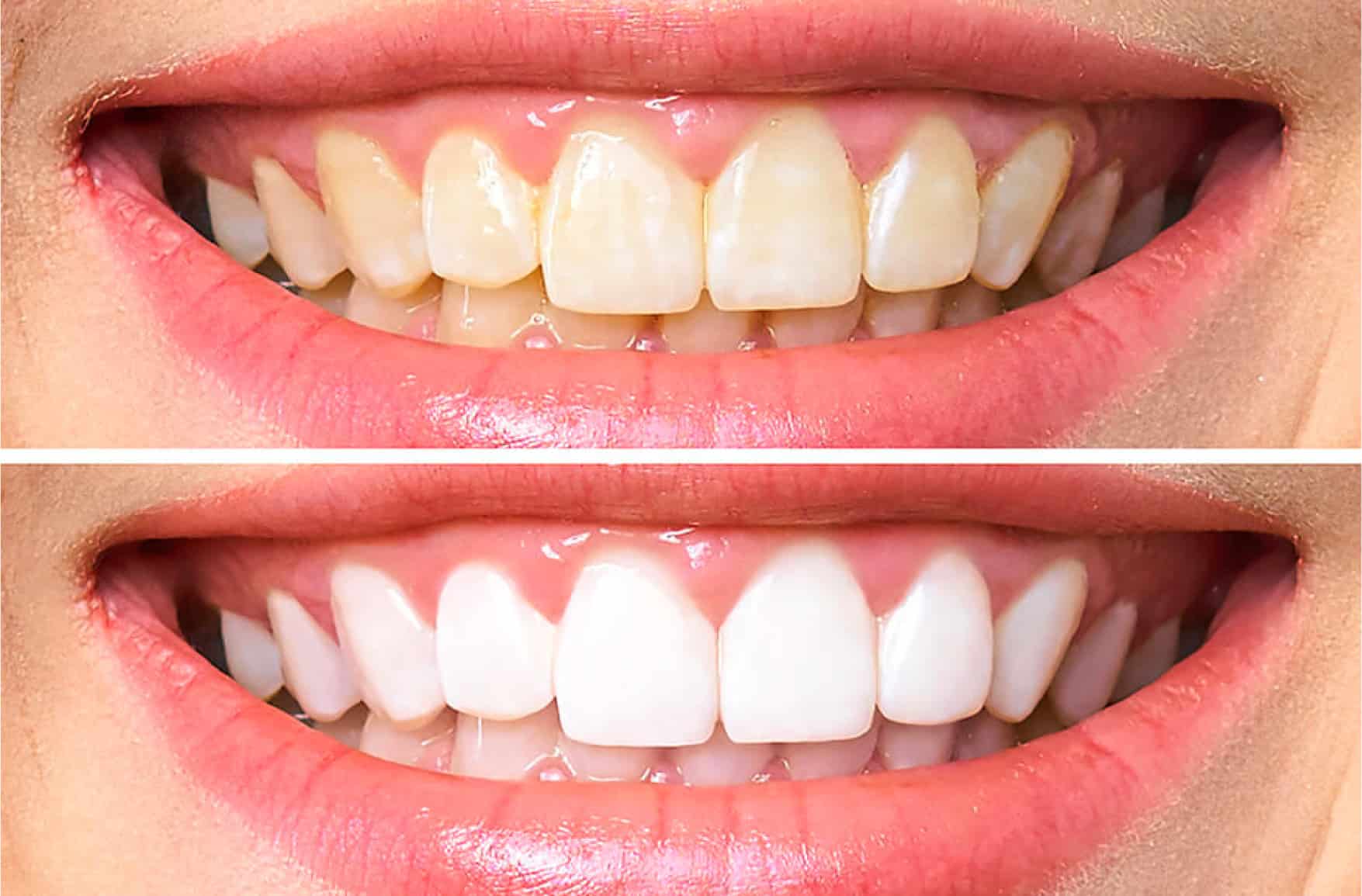 teeth cleaning before and after