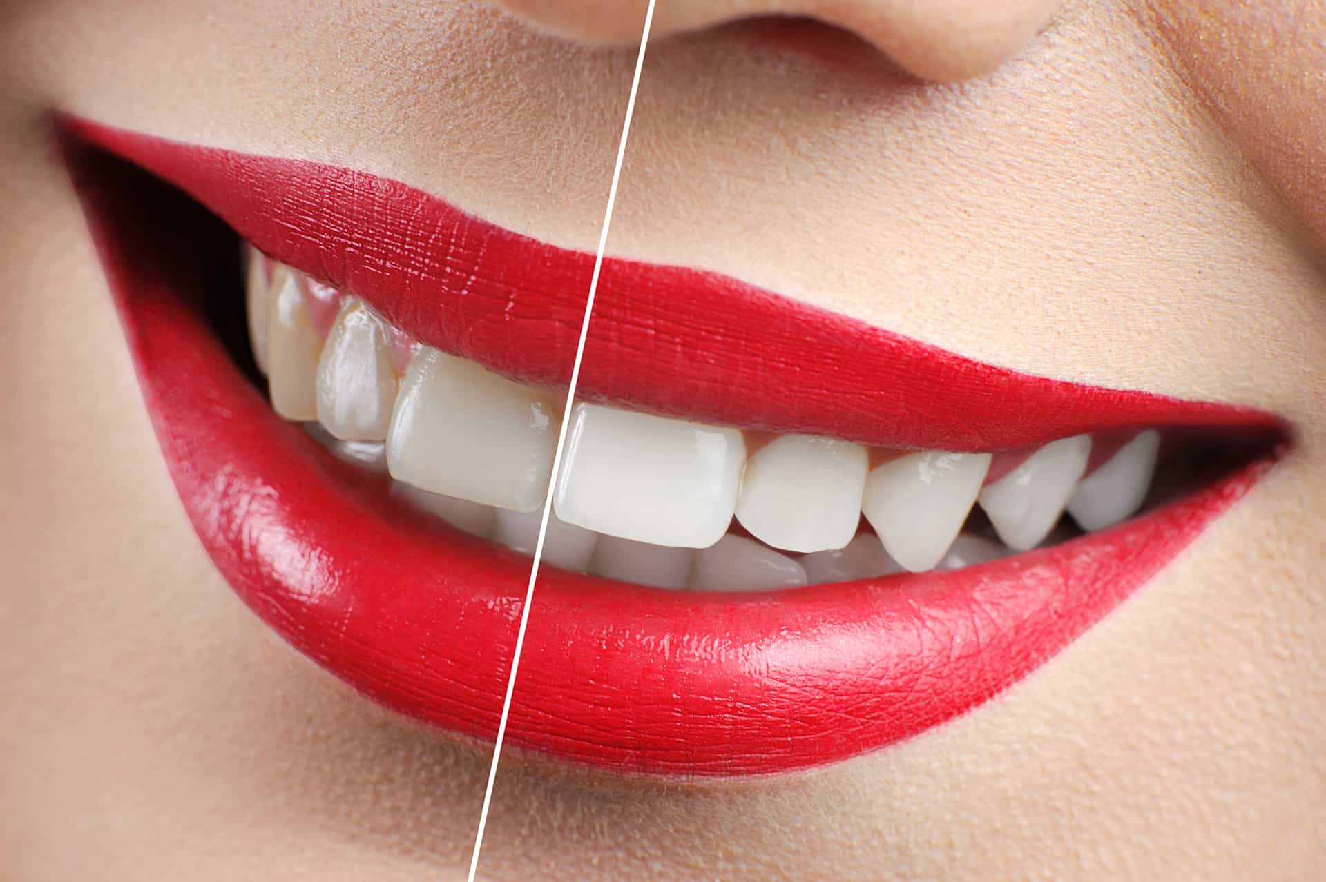 cosmetic dentist teeth whitening
