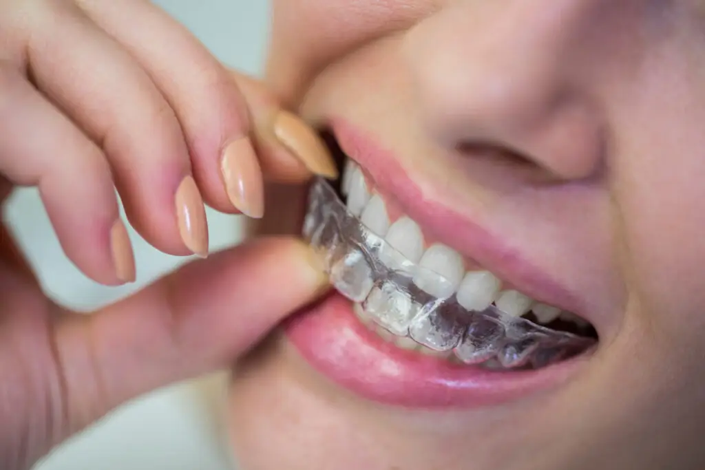 Woman wearing a clear Invisalign aligner while receiving dental care for teeth straightening.